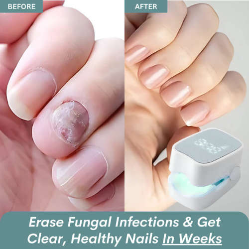 quenastore™ - Nail Fungus Laser Device