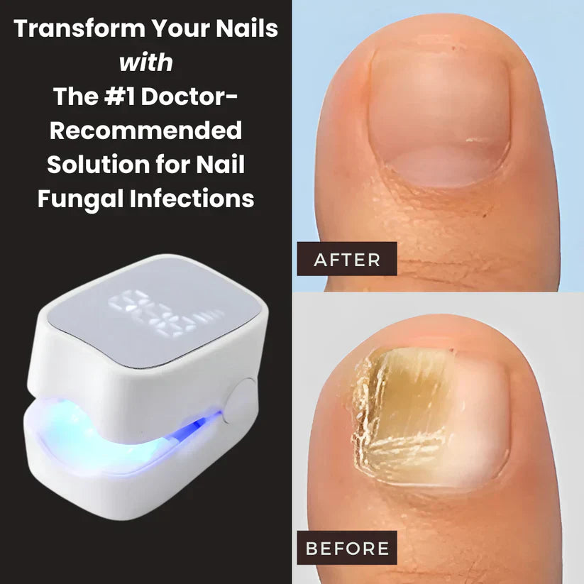 quenastore™ - Nail Fungus Laser Device